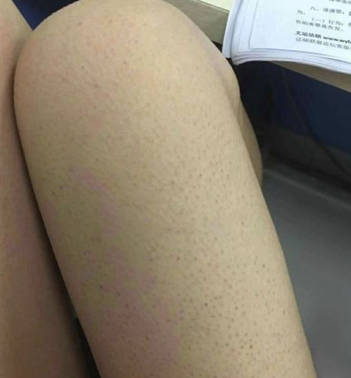 去除雞皮膚的小妙招,讓你的肌膚煥發(fā)自然光彩,雞皮膚改善秘訣,輕松告別不光滑,肌膚煥發(fā)自然光彩小妙招