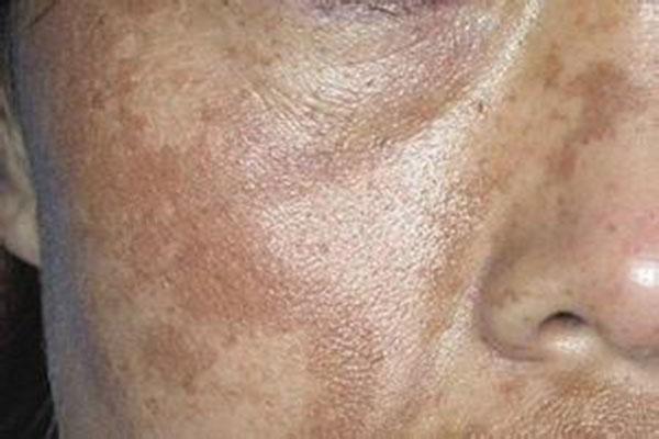 如何排出臉上的毒素——打造健康肌膚光彩,臉部排毒秘訣,打造健康肌膚光彩的秘訣