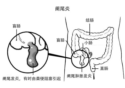 如何判斷闌尾炎的六個方法,判斷闌尾炎的六種方法詳解