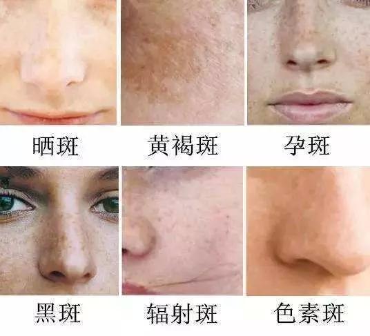 如何有效去除臉上斑點——全方位指南,全方位指南,如何有效去除臉上斑點