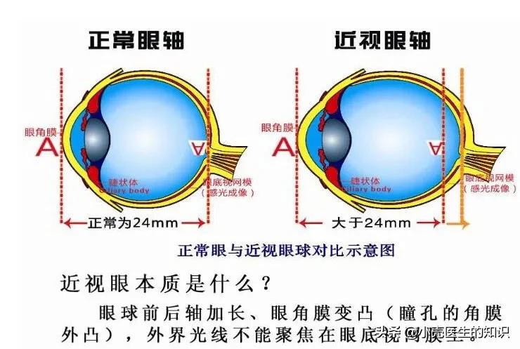 造成近視眼的十大原因,近視眼的十大成因分析