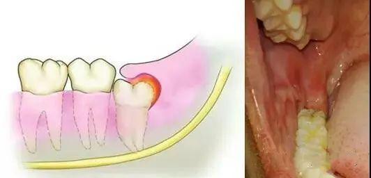 拔智齒多少錢一顆?一文解讀智齒拔除費(fèi)用(2022年),2022年智齒拔除費(fèi)用詳解,拔智齒多少錢一顆?一文解讀智齒拔除費(fèi)用問題。