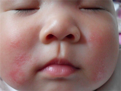 嬰兒濕疹快速消退方法,全面解析與實用指南,嬰兒濕疹全面解析與快速消退實用指南