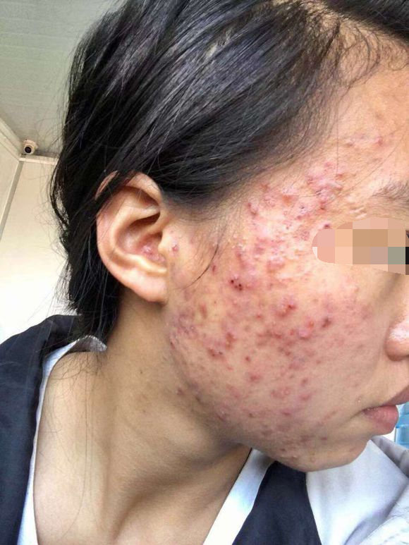 青春痘怎么才能好,全面解析青春痘成因與治療方法,全面解析青春痘成因與治療方法,助你擺脫青春痘困擾