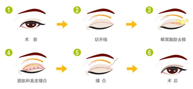 成都雙眼皮手術(shù),尋找最優(yōu)秀的醫(yī)療機(jī)構(gòu),成都雙眼皮手術(shù)最佳醫(yī)療機(jī)構(gòu)尋找指南