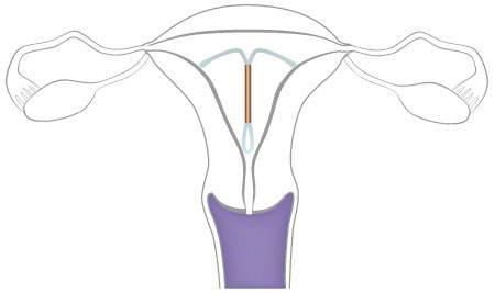 上環對身體有什么影響,全面解析與指導建議,全面解析與指導建議,上環對身體的影響及注意事項