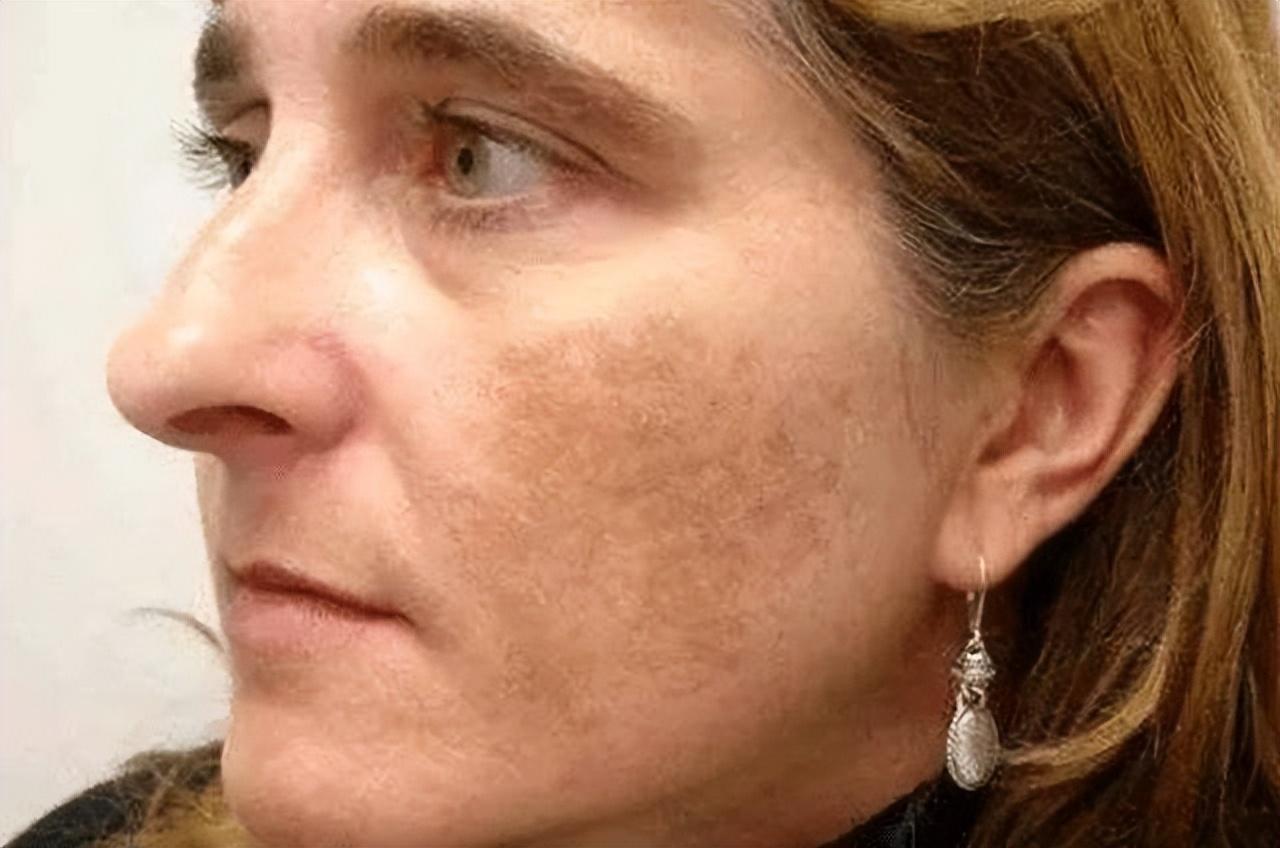 如何有效去除老年斑——全方位指南,全方位指南,如何有效去除老年斑