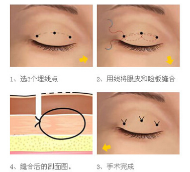 雙眼皮埋線手術(shù)效果持久性解析,持續(xù)時(shí)間與影響因素探討,雙眼皮埋線手術(shù)的持久性與影響因素深度解析