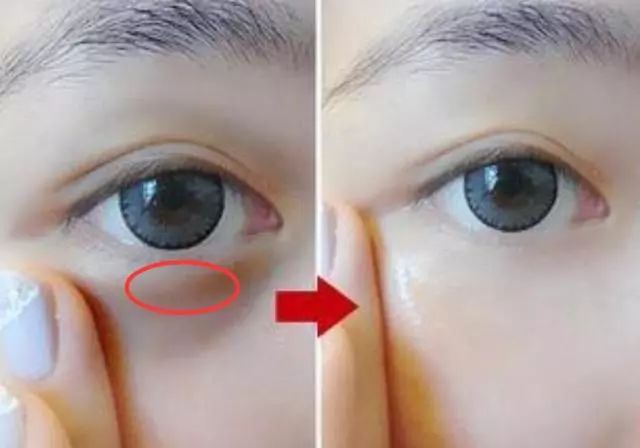 去除黑眼圈眼袋的有效方法,有效消除黑眼圈眼袋的方法