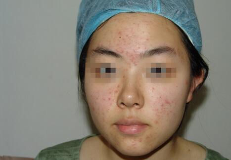 激光祛痘痘有效果嗎,深度解析與全面理解,激光祛痘效果深度解析與全面理解指南