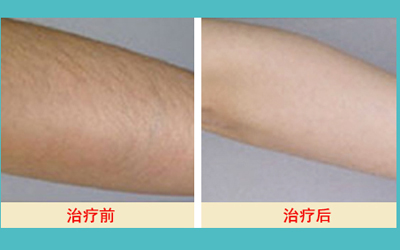 激光脫毛的價格解析，多少錢才能擁有絲滑肌膚？，激光脫毛價格詳解，多少錢能擁有絲滑肌膚？